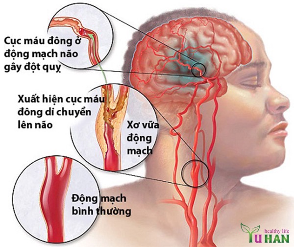 bệnh đột quỵ là bệnh gì