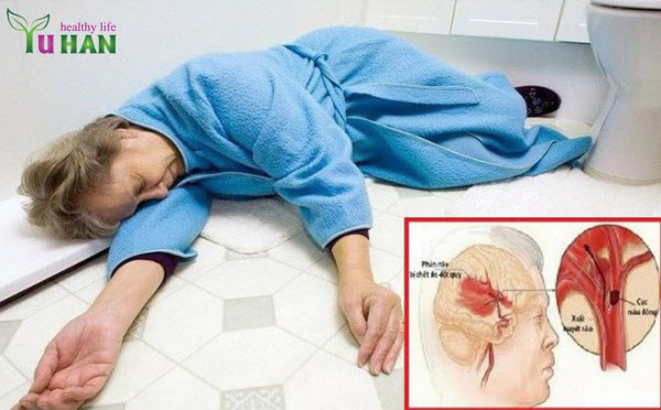 đột quỵ não