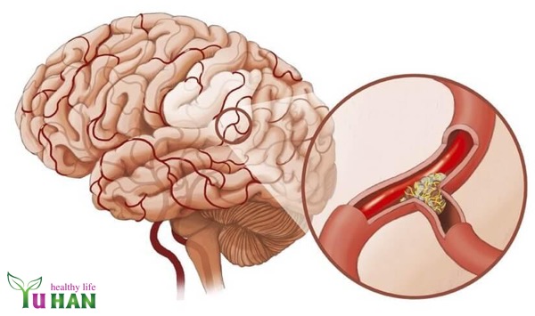 bệnh đột quỵ và tai biến mạch máu não