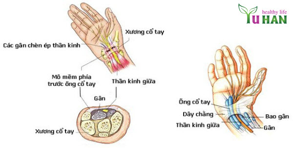 bệnh tê bại chân tay