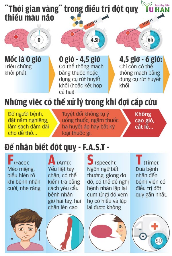 đột quỵ cấp tính