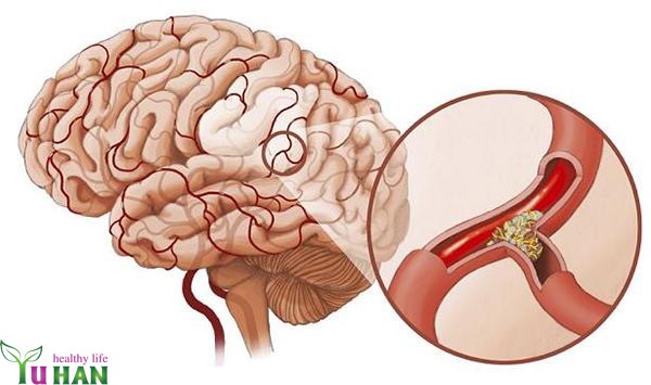 bệnh đột quỵ
