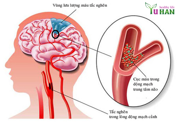 đột quỵ não