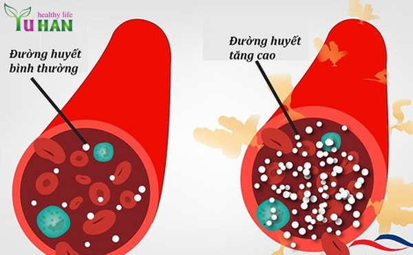 bệnh tê tay chân ở người tiểu đường