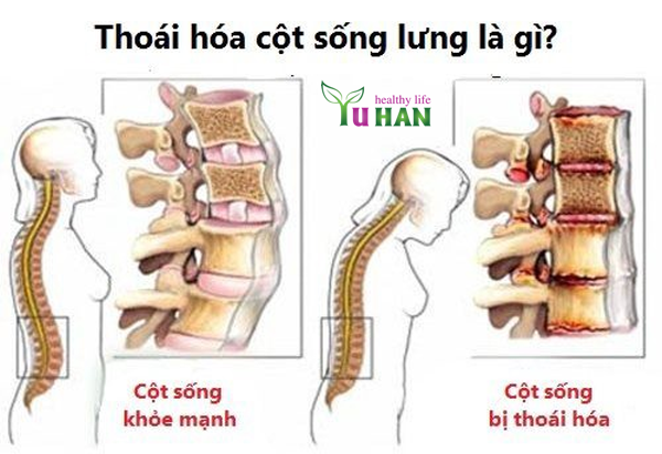 bệnh tê bại tay chân