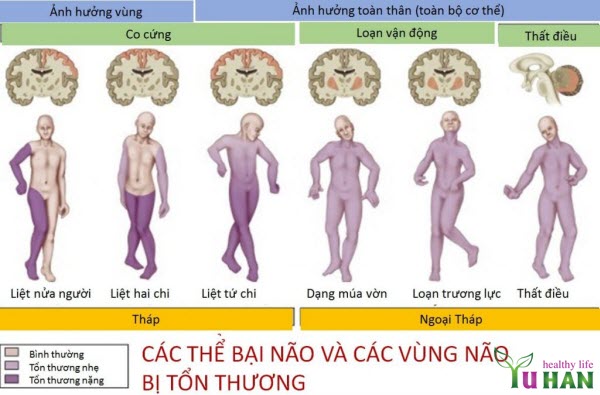 dấu hiệu bệnh bại liệt