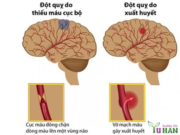 bệnh đột quỵ não