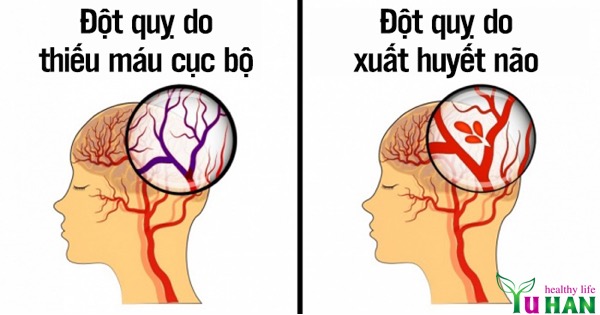 bệnh đột quỵ não