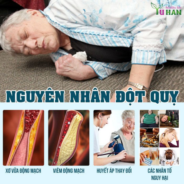 đột quỵ cấp tính