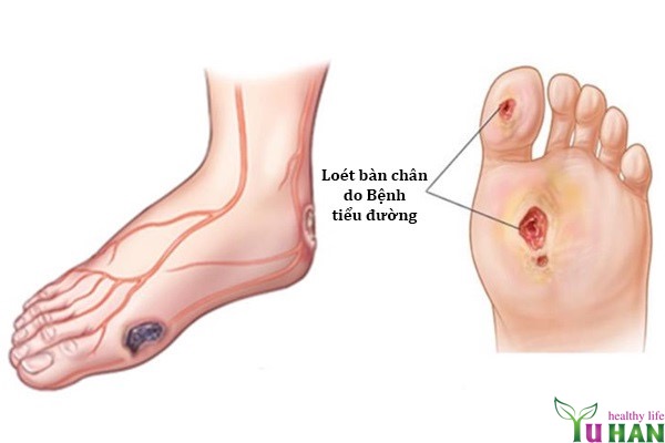 bệnh tiểu đường và cách chữa trị