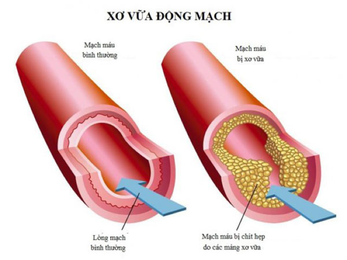 2 loại tai biến mạch máu não