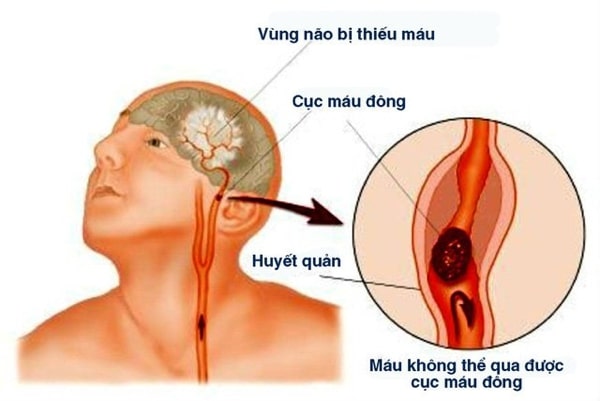 bệnh án đột quỵ nhồi máu não