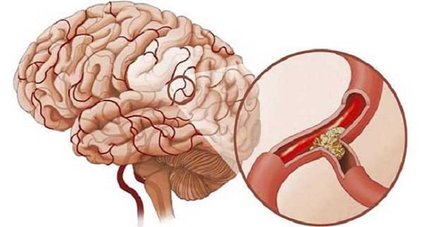 bệnh án đột quỵ nhồi máu não