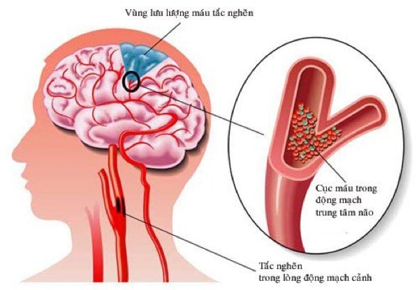 bệnh án đột quỵ nhồi máu não