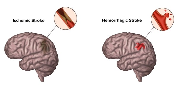 bệnh đột quỵ là bệnh gì