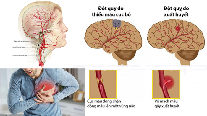 bệnh đột quỵ là gì