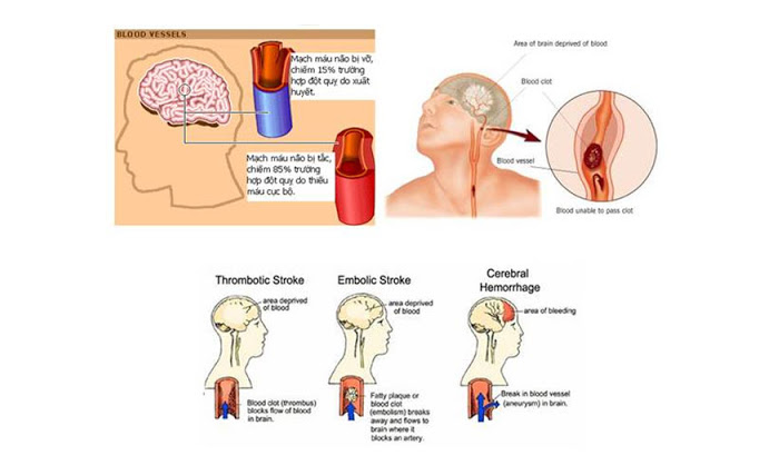 bệnh đột quỵ là gì