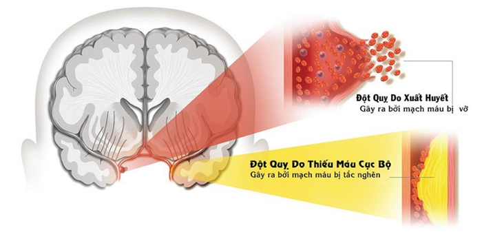 bệnh đột quỵ là sao