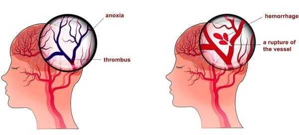 bệnh đột quỵ mạch máu não