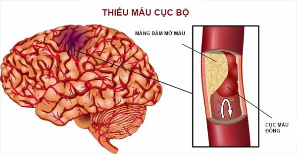 bệnh đột quỵ não