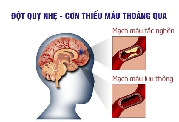 bệnh đột quỵ nhẹ