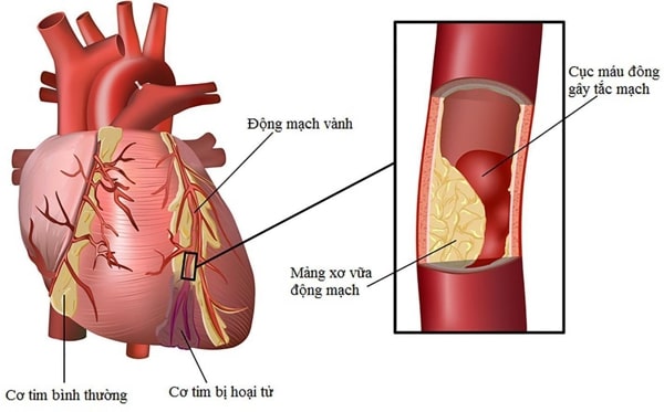 bệnh đột quỵ nhồi máu cơ tim