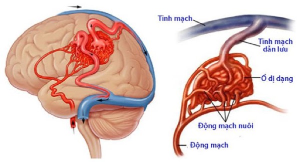 bệnh đột quỵ và cách phòng ngừa 