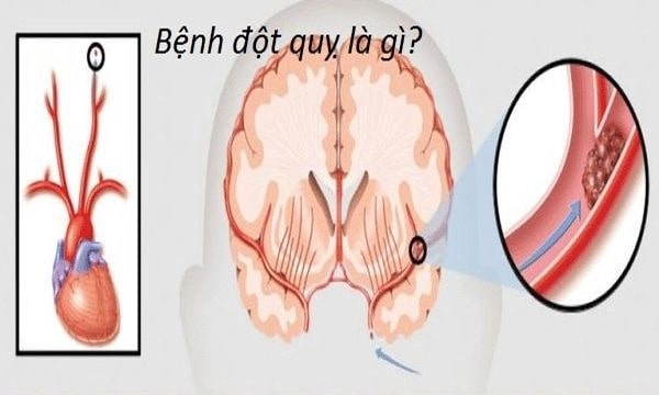 bệnh đột quỵ