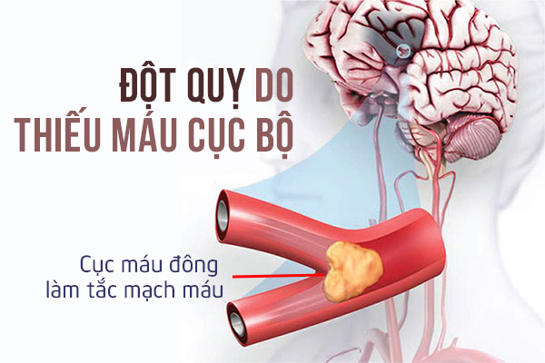 bệnh lý đột quỵ não