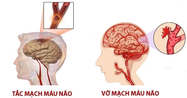 bị tai biến mạch máu não điều trị 