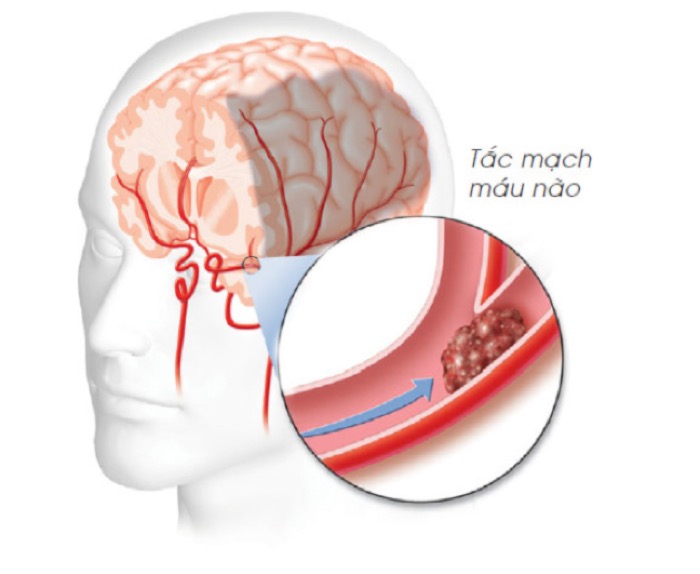 cách đề phòng bệnh đột quỵ