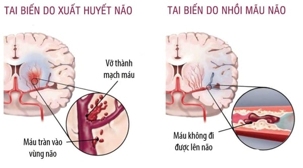 cách khám tai biến mạch máu não