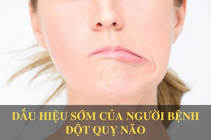 cách phát hiện bệnh đột quỵ