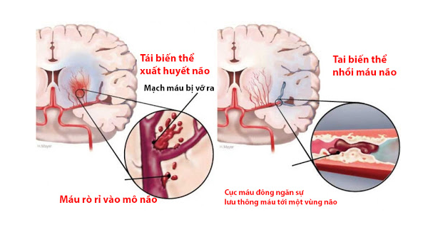 dấu hiệu bệnh đột quỵ não