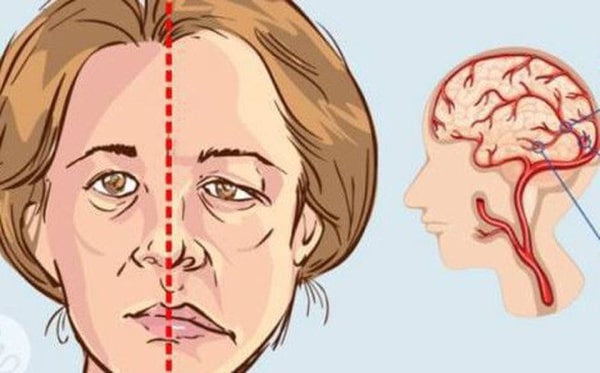 di chứng của bệnh đột quỵ