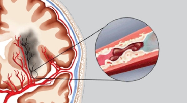 đột quỵ có phải bệnh hiểm nghèo