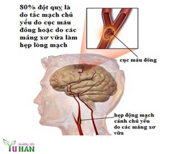 đột quỵ cấp tính