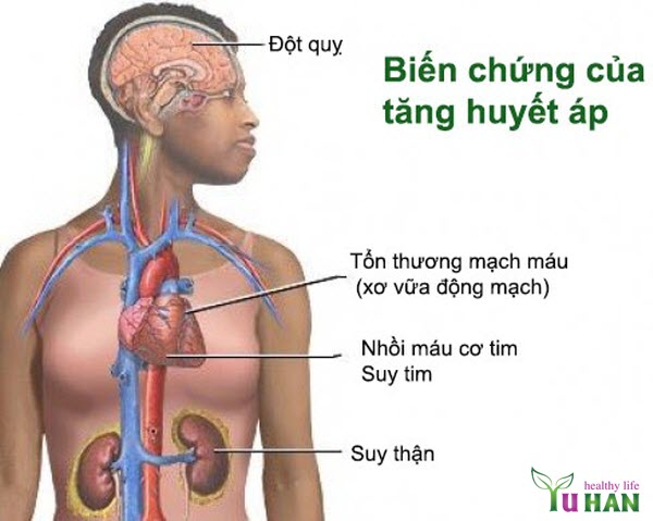 đột quỵ và tăng huyết áp