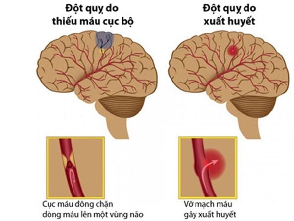 nguy cơ tai biến mạch máu não