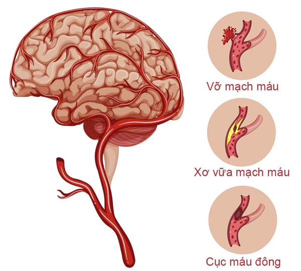 nguyên nhân gây ra bệnh tai biến mạch máu não