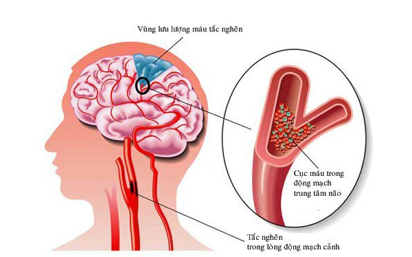 phòng bệnh đột quỵ não