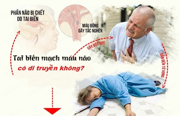 tai biến mạch máu não có di truyền không