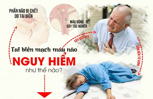 tai biến mạch máu não có nguy hiểm không