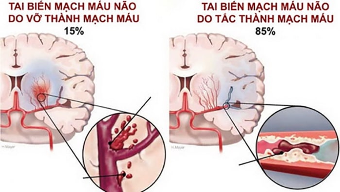 tai biến mạch máu não của Hàn Quốc