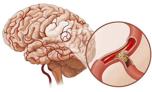 tai biến mạch máu não giai đoạn bán cấp