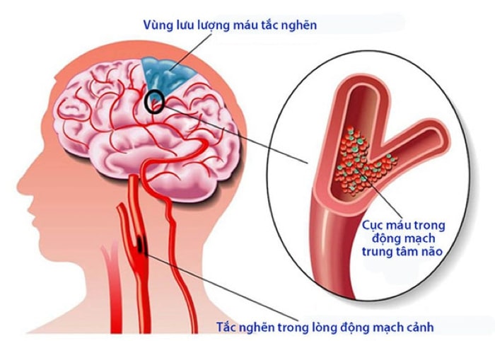 tai biến mạch máu não là gì