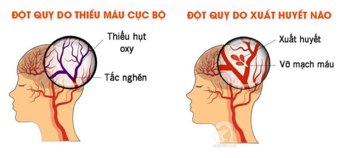 tai biến mạch máu não làm sao