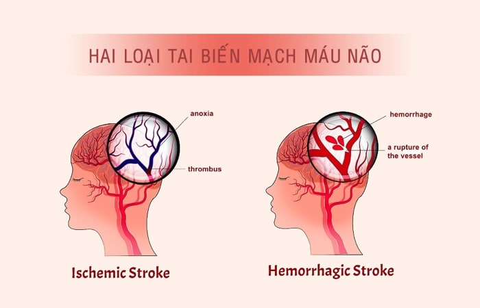 tai biến mạch máu não mạn tính