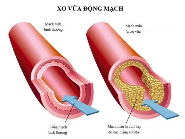 tai biến mạch máu não nặng có chữa được không