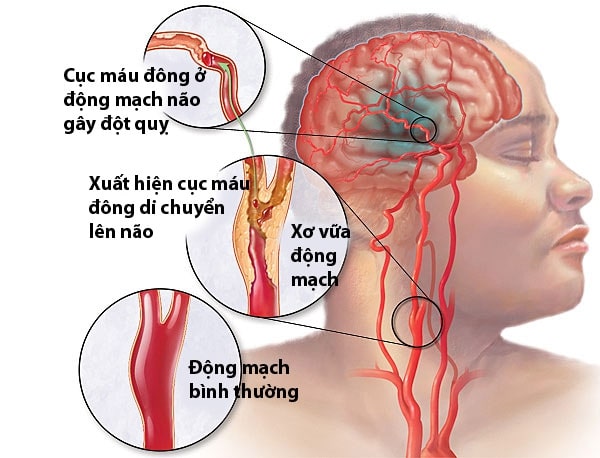 tai biến mạch máu não ở người trẻ